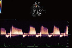 Cardiac Pulmonary Regurgitation