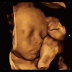 3D of Fetal Face