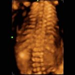 3D of Fetal Spine