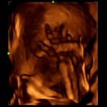 3D of Fetal Hand